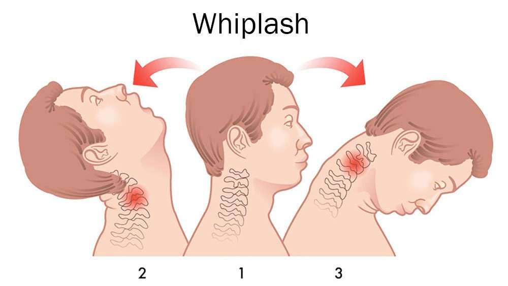 Whiplash Injuries